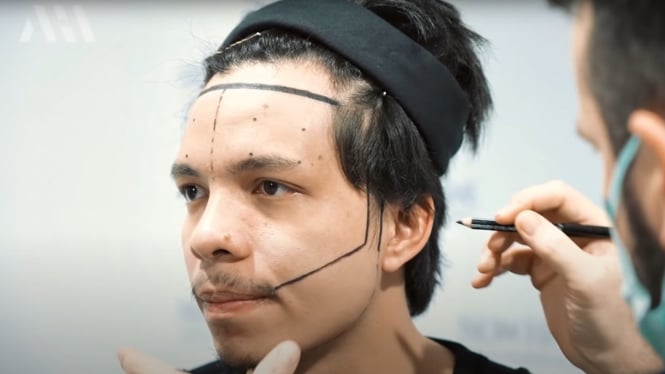 Terungkap, Alasan Transplantasi Rambut Teruji Jadi Solusi Efektif Tangani Kebotakan dan Kerontokan